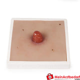 Erler-Zimmer Wundmoulage inkl. Stativ.