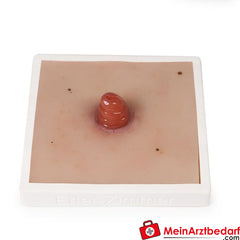 Erler-Zimmer Wundmoulage inkl. Stativ.