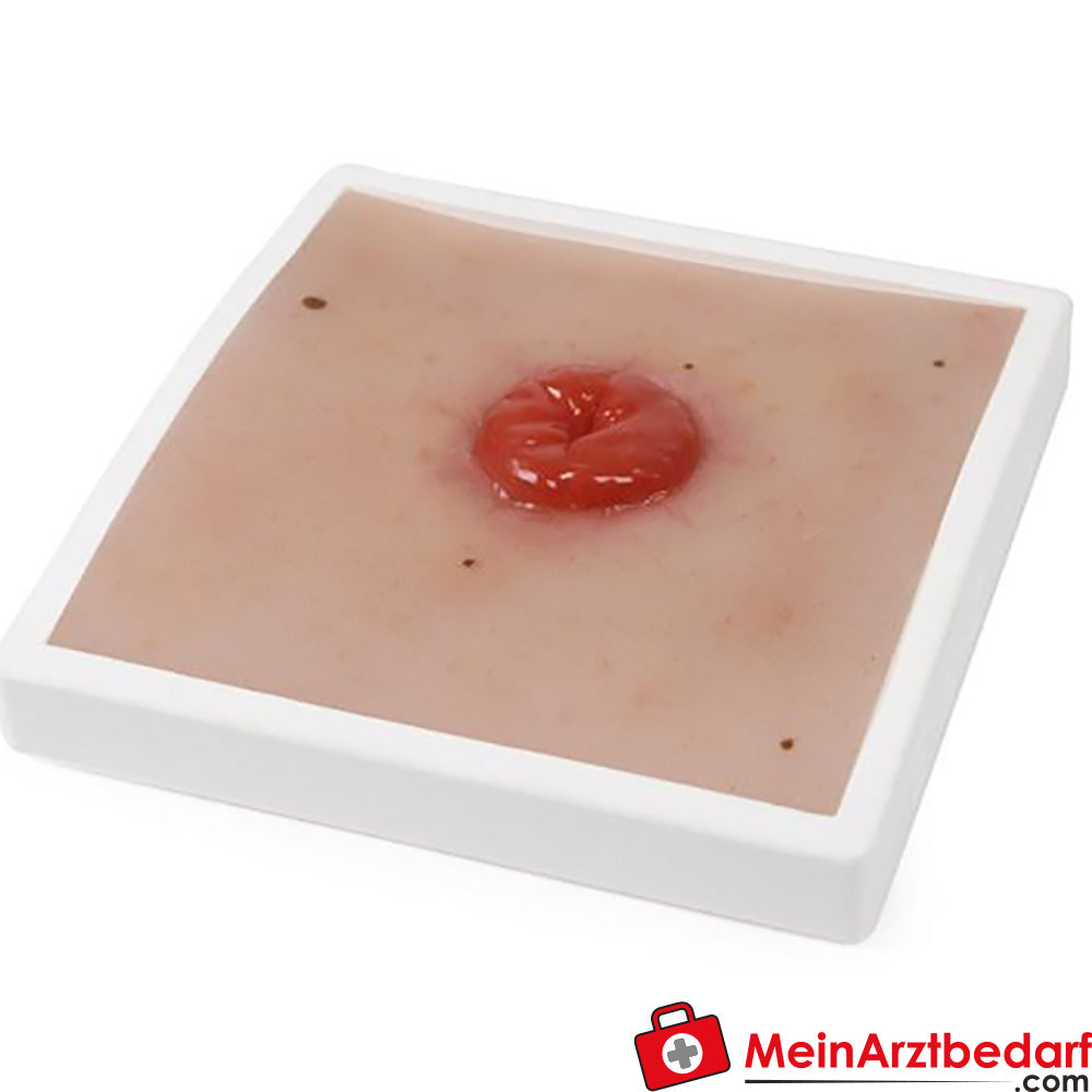 Erler-Zimmer Wundmoulage inkl. Stativ.