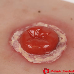 Erler-Zimmer Wundmoulage inkl. Stativ.