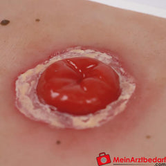 Erler-Zimmer Wundmoulage inkl. Stativ.