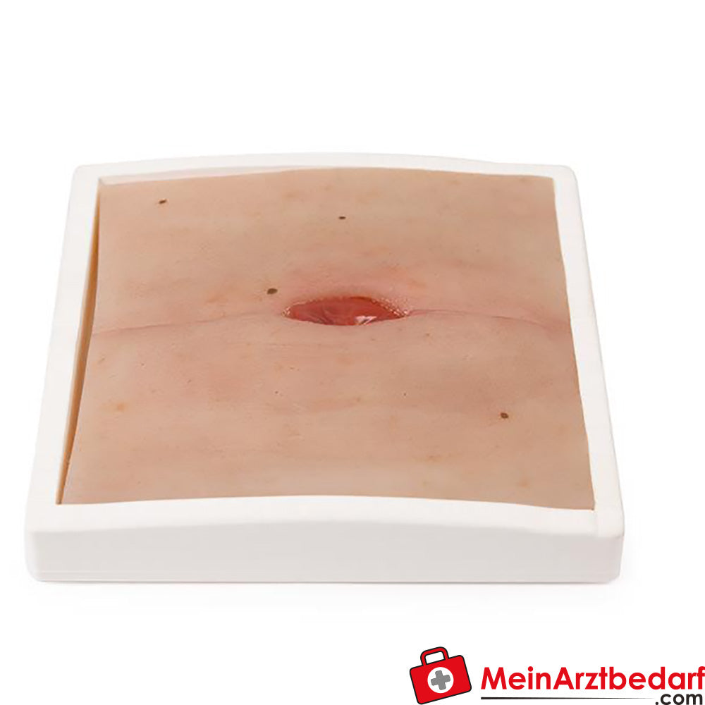 Erler-Zimmer Wundmoulage inkl. Stativ.