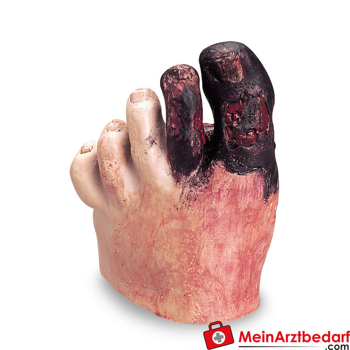 Erler Zimmer Diabetes foot