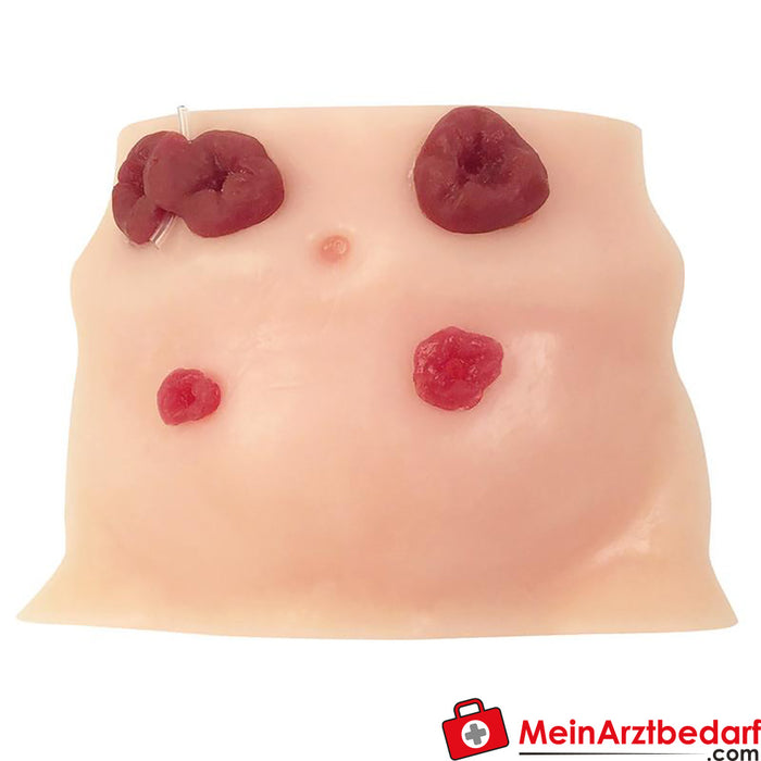 Erler Zimmer Stoma Care Simulator