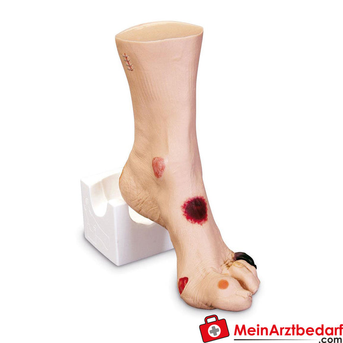 Erler Zimmer "Wilma" wound foot