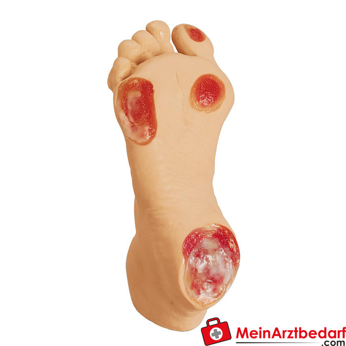 Erler Zimmer Senior Pressure Ulcer Foot