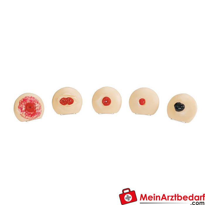 Erler Zimmer Stoma care practice model set