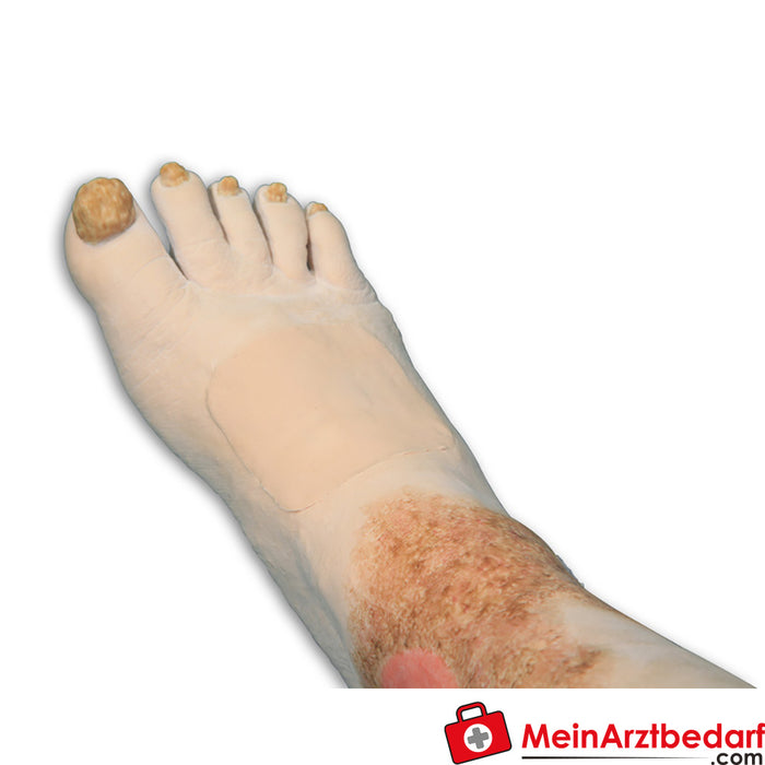 Erler Zimmer Vinnie, leg with venous insufficiency