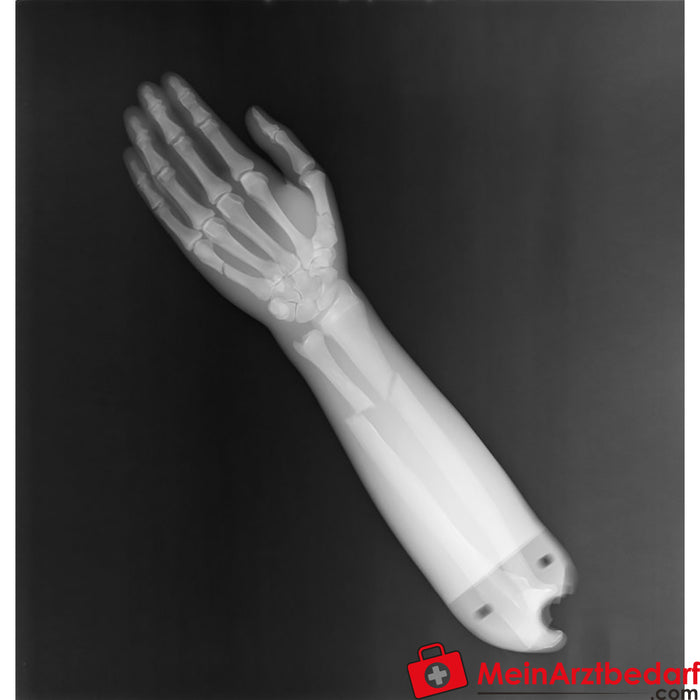 Erler - zimer fractura del antebrazo mano r16900