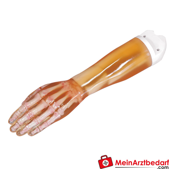 Erler - zimer fractura del antebrazo mano r16900