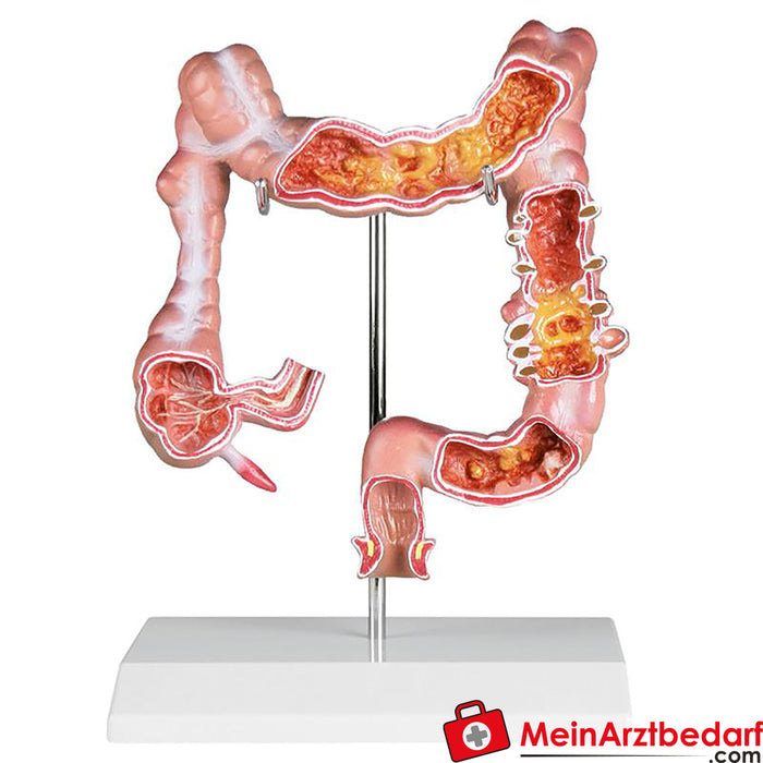 Modelo de colon de Erler Zimmer con enfermedades