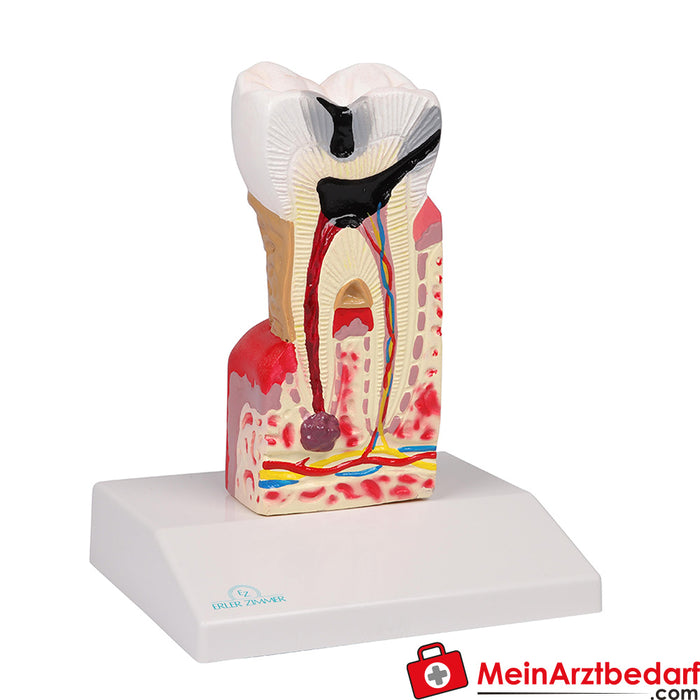 Erler Zimmer Modello di carie dentale - formato 10x